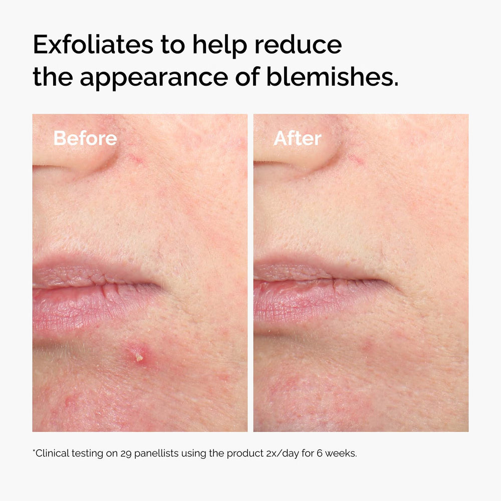 Salicylic Acid 2% Solution