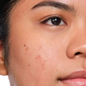 Pigmentation →